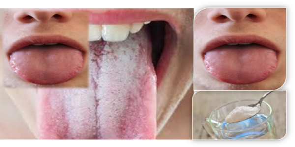 "Lengua Blanca: Causas, Remedios Naturales y Cómo Recuperar una Boca Saludable"